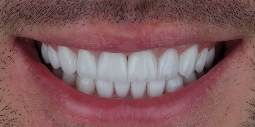 dental veneers dis kaplamalari