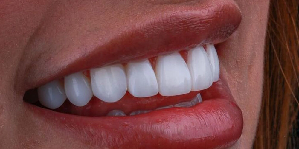 zirconium crowns zirkonyum kaplamalar