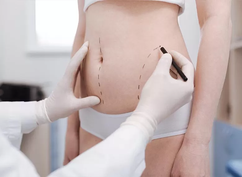 liposuction-1.jpg