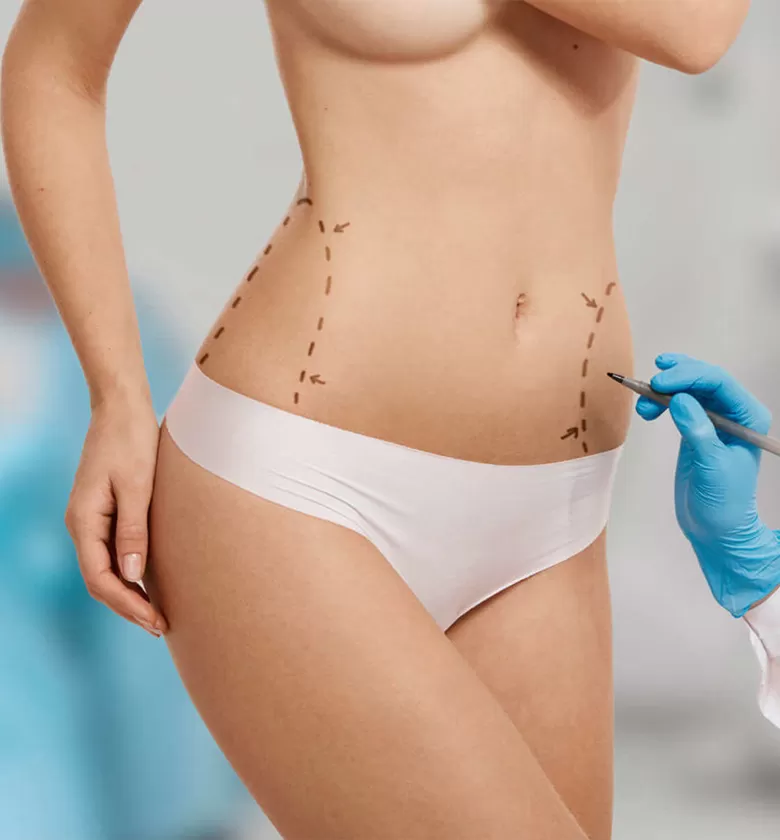 liposuction-2.jpg